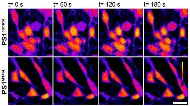 Alzheimer familiar: crean neuronas humanas para entender los mecanismos de la neurodegeneración