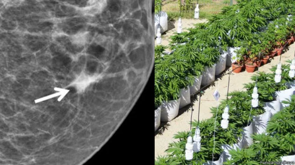 Un receptor cannabinoide logró frenar el desarrollo agresivo de cáncer de mama