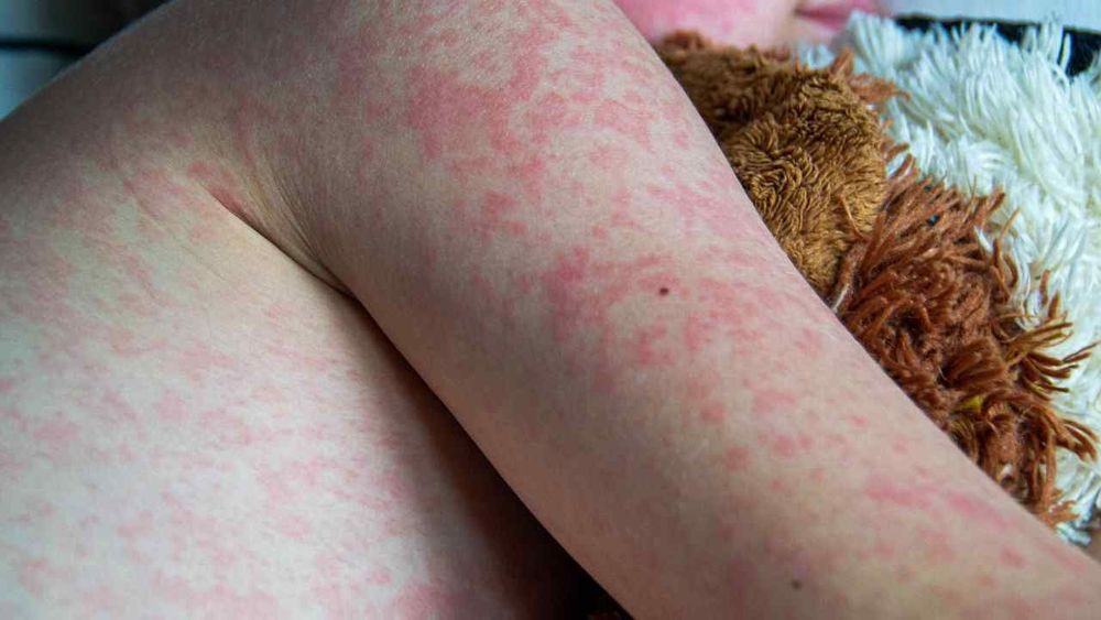 Crece el brote de sarampión en Río Negro: ya son 11 los confirmados y 10 más son sospechosos