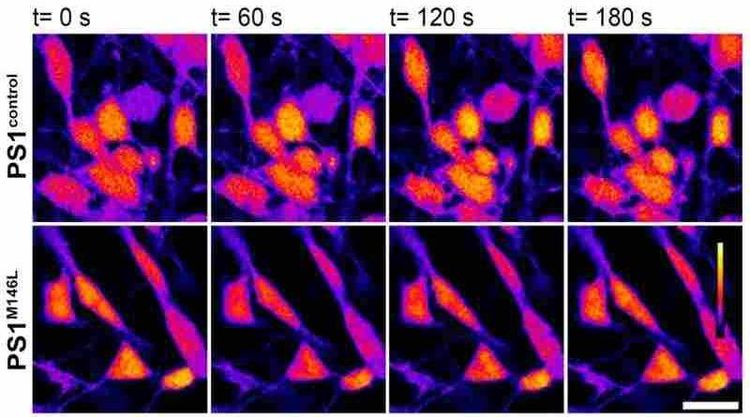 Alzheimer familiar: crean neuronas humanas para entender los mecanismos de la neurodegeneración