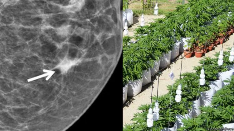 Un receptor cannabinoide logró frenar el desarrollo agresivo de cáncer de mama