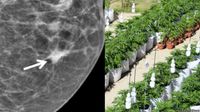 Un receptor cannabinoide logró frenar el desarrollo agresivo de cáncer de mama
